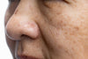 close-up of the side of an older woman's face who has dark spots on her cheek and nose.